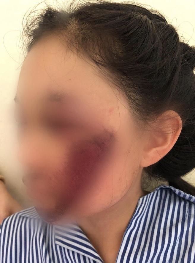 Váy chống nắng cuốn vào bánh xe, nữ sinh ngã xuống đường, xây xát mặt
