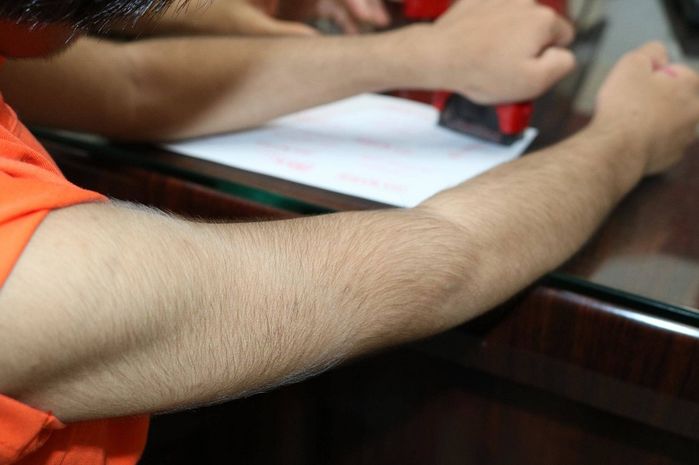 Căn bệnh lạ xuất hiện đầu tiên ở Việt Nam, cả thế giới chỉ có 74 ca
