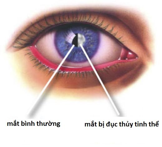 MC xinh đẹp của VTV bị đục thủy tinh thể, nguy cơ mù khá cao