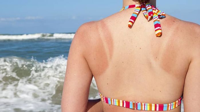 Chữa cháy nắng đơn giản nhờ những món có sẵn trong nhà: sữa, cà chua