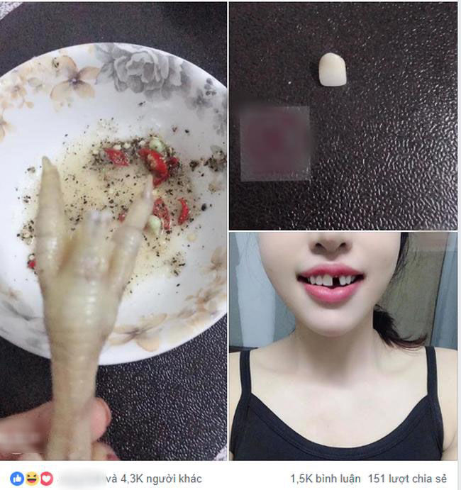 Chỉ vì ăn chân gà luộc, cô gái bị rụng luôn chiếc răng cửa