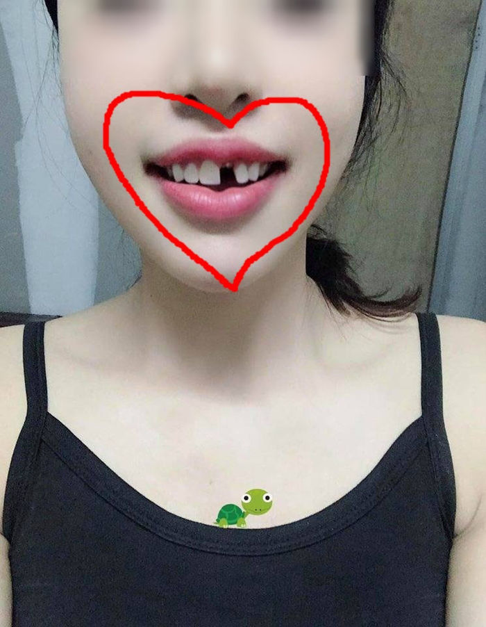 Chỉ vì ăn chân gà luộc, cô gái bị rụng luôn chiếc răng cửa