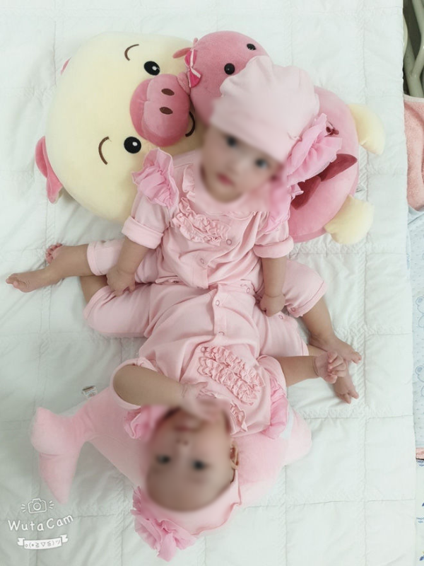Ca phẫu thuật định mệnh của 2 bé gái dính nhau vùng bụng