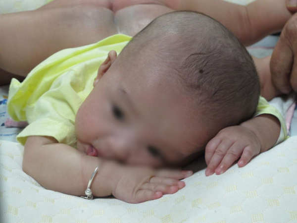 Ca phẫu thuật định mệnh của 2 bé gái dính nhau vùng bụng