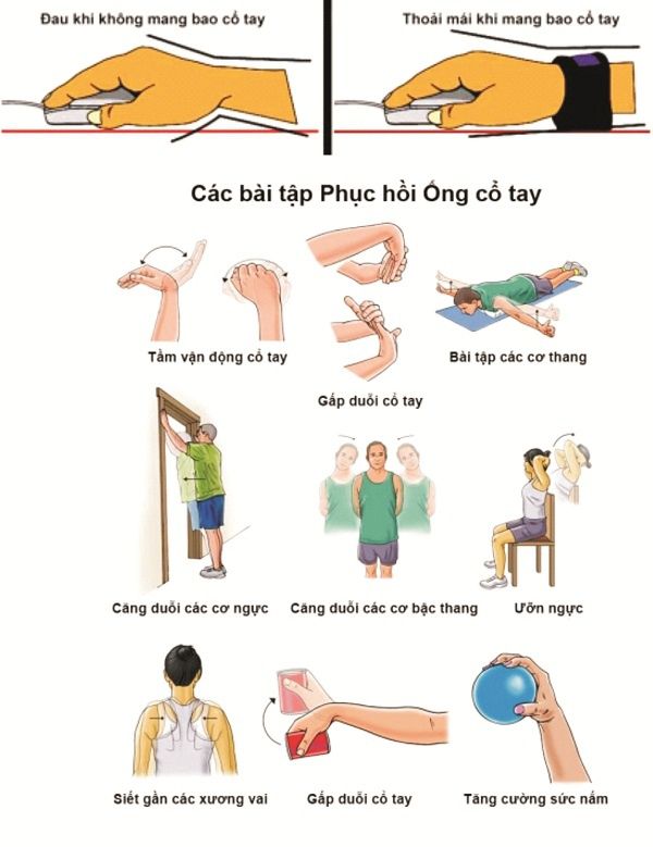 Hay đeo dây cột tóc ở cổ tay, người phụ nữ mắc hội chứng ống cổ tay