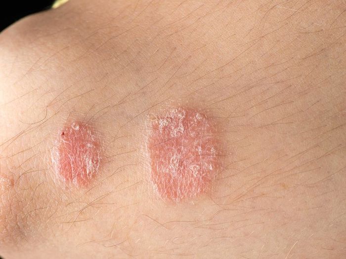 Hôn trai lạ, cô gái bị bệnh vảy nến đến nỗi tự ti không dám ra khỏi