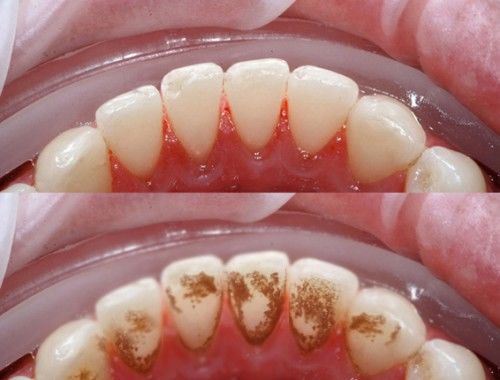 Lấy cao răng dễ như ăn kẹo bằng hỗn hợp backing soda, muối, chanh