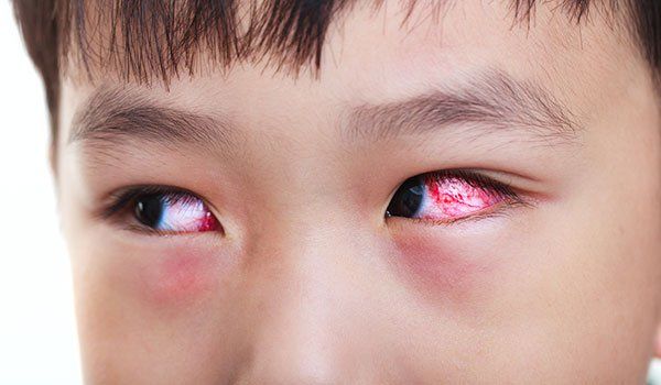 Mắt giật chẳng phải điềm báo gặp lại người cũ mà là dấu hiệu của bệnh