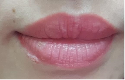 Sau 3 ngày xăm môi, người phụ nữ nhiễm Herpes rồi phát ban toàn thân
