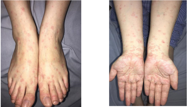 Sau 3 ngày xăm môi, người phụ nữ nhiễm Herpes rồi phát ban toàn thân