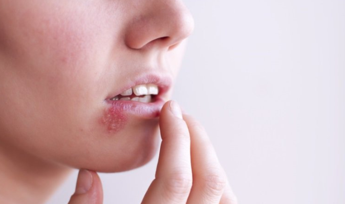 Sau 3 ngày xăm môi, người phụ nữ nhiễm Herpes rồi phát ban toàn thân