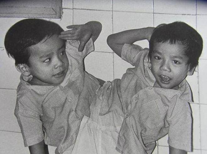Khoảnh khắc khó quên của cả ekip sau ca tách dính 1988: Sống rồi!