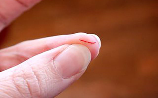 Bị vết thương nhẹ lúc rửa tôm, chàng trai bị hoại tử phải cắt ngón tay