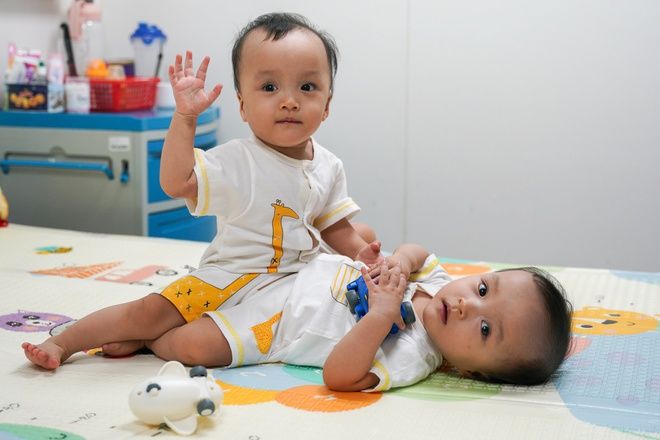Tình hình sức khoẻ cặp song sinh dính liền sau 1 tuần tách rời