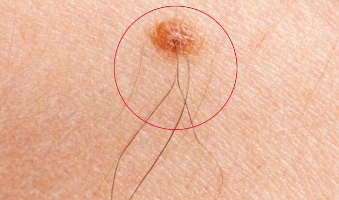 4 vị trí mọc lông tưởng xấu mà tốt, càng mọc nhiều càng phát tài