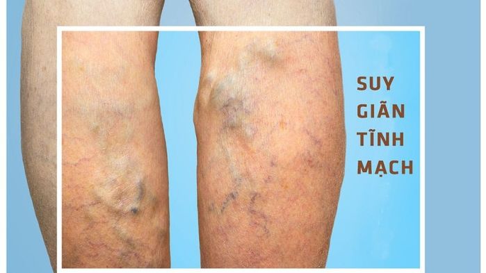 7 bài tập giúp giảm tình trạng suy giãn tĩnh mạch chân