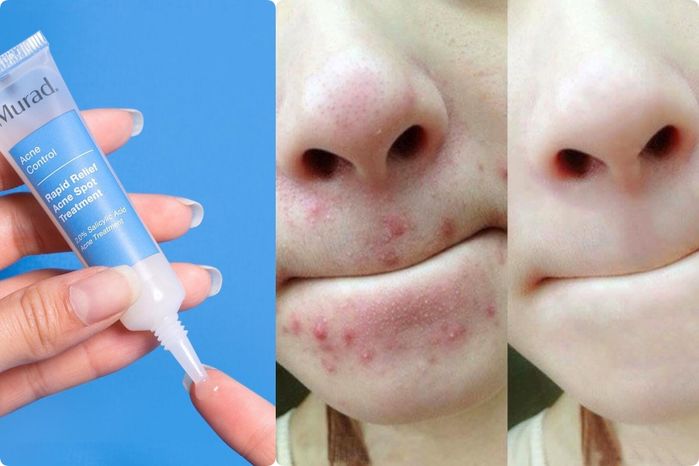 5 loại kem trị mụn siêu nhanh: Có gel cho da nhạy cảm, xẹp mụn sau 4h