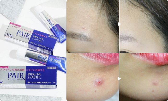 5 loại kem trị mụn siêu nhanh: Có gel cho da nhạy cảm, xẹp mụn sau 4h