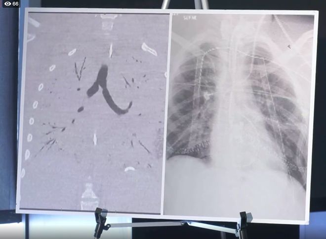Bệnh nhân Covid-19 đầu tiên ở Mỹ sống sót nhờ ghép phổi