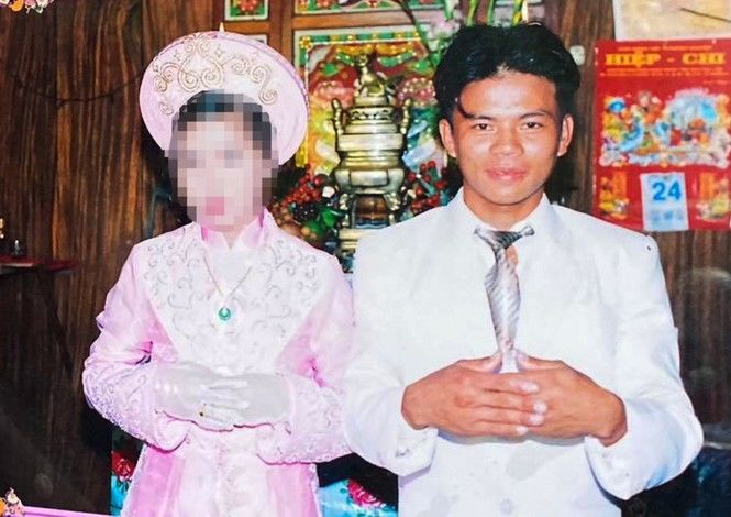 Ca đại phẫu tái tạo dung nhan cho chàng trai mặt bị biến dạng