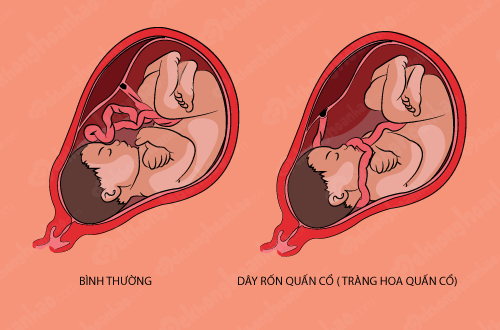 Mổ cấp cứu thành công bé trai bị 6 vòng dây rốn quấn cổ
