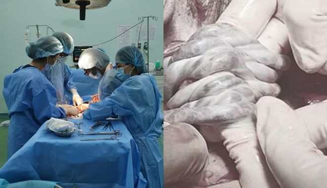 Mổ cấp cứu thành công bé trai bị 6 vòng dây rốn quấn cổ
