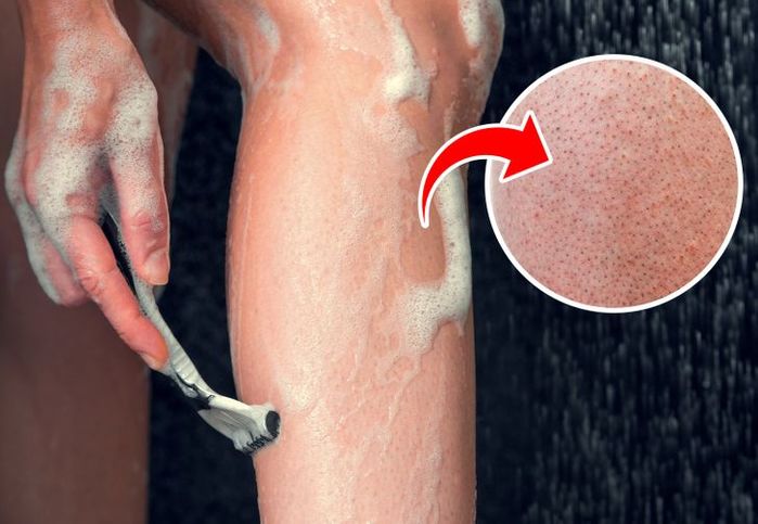 4 lí do khiến chân sần sùi đốm đen như quả dâu tây
