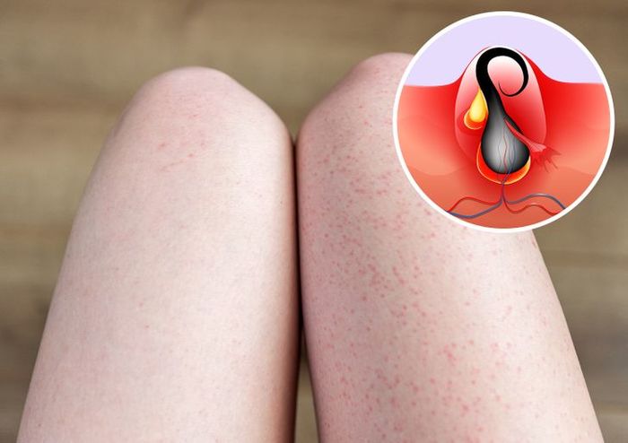 4 lí do khiến chân sần sùi đốm đen như quả dâu tây