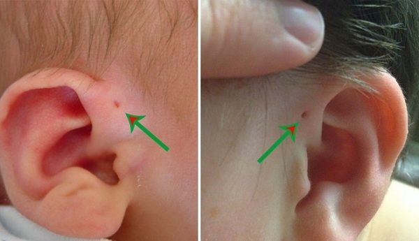 Tiến sĩ Singapore nói về lỗ nhỏ trên tai: lành tính hoặc do di truyền