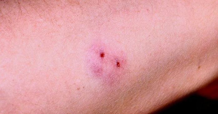 TS.BS Công Tình: Không tự ý cứu chữa tại nhà khi bị rắn cắn