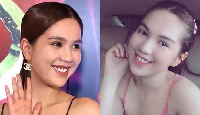 Sao Việt đẹp hơn nhờ chỉnh răng: Thủy Tiên lột xác ấn tượng nhất