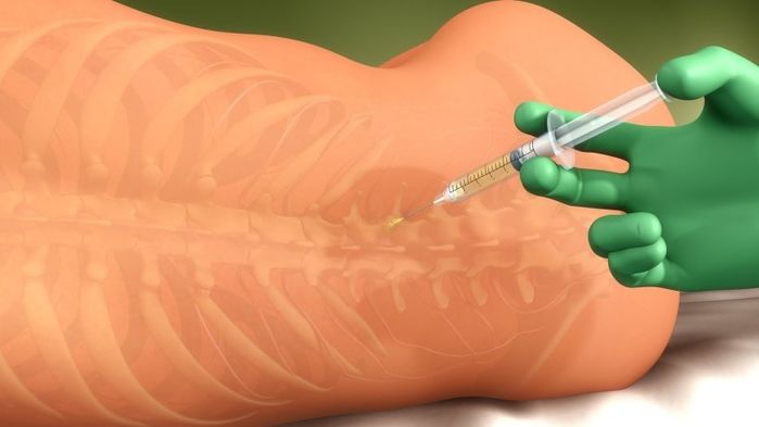 Sau mũi gây tê tủy sống, mẹ sinh mổ phải chịu đau đớn cả đời