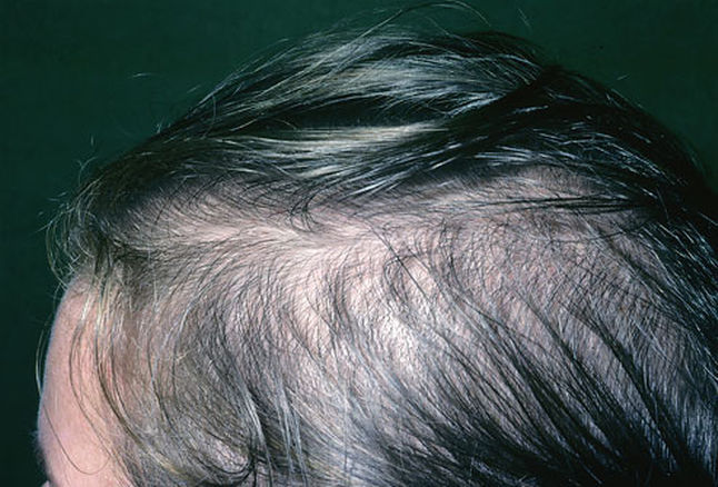 6 mẹo kích thích tóc mọc chỗ bị hói: Đắp tinh dầu gừng, tắm nắng