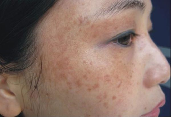 Dọn sạch nám chi chít chỉ với vài giọt nước cà chua, chanh, mật ong