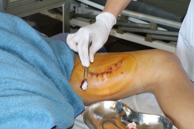 Bình rượu ổi ngâm 1 năm phát nổ khiến người đàn ông bị rách đùi
