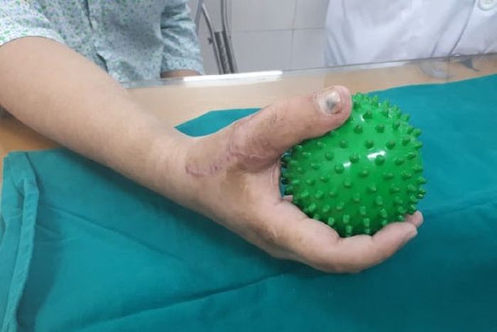 Bị dập nát ngón cái, nam thanh niên được chuyển ngón chân làm ngón tay