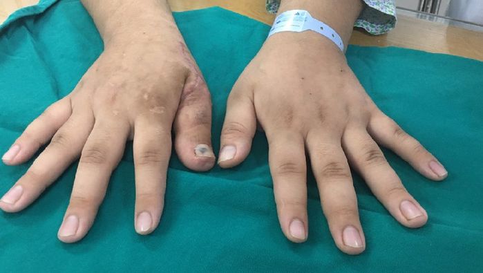 Bị dập nát ngón cái, nam thanh niên được chuyển ngón chân làm ngón tay