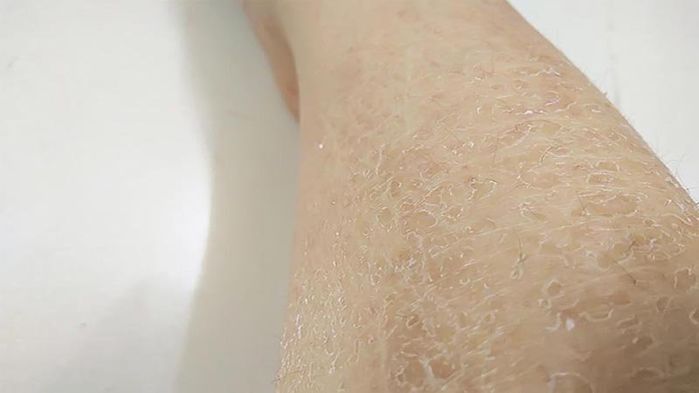 Dấu hiệu cho thấy cơ thể đang thiếu canxi: Mất ngủ, hay bị chuột rút