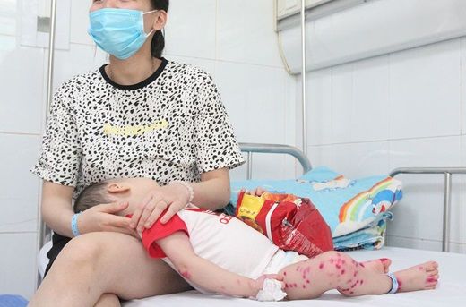 Trẻ mắc tay chân miệng: Quấy khóc, nôn là dấu hiệu biến chứng lên não