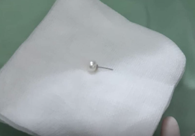 Phú Thọ: Bác sĩ gắp kim khâu gỉ đen 17mm từ trong cơ thể bé gái 3 tuổi