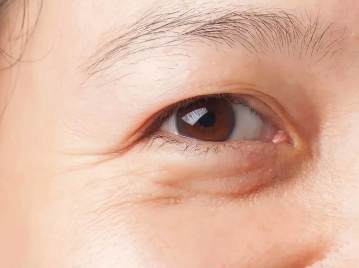 Mỡ mí mắt to khiến gương mặt già trước tuổi: Đắp nha đam, khoai tây