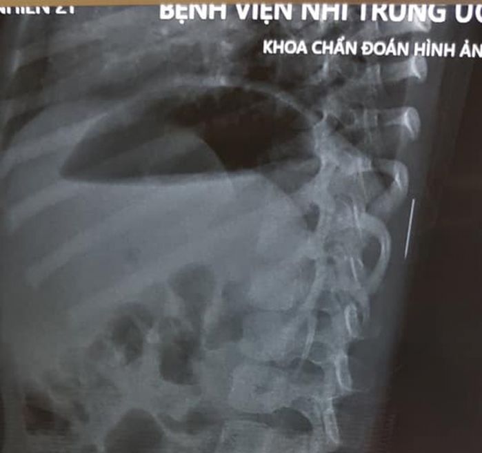 Phú Thọ: Bác sĩ gắp kim khâu gỉ đen 17mm từ trong cơ thể bé gái 3 tuổi