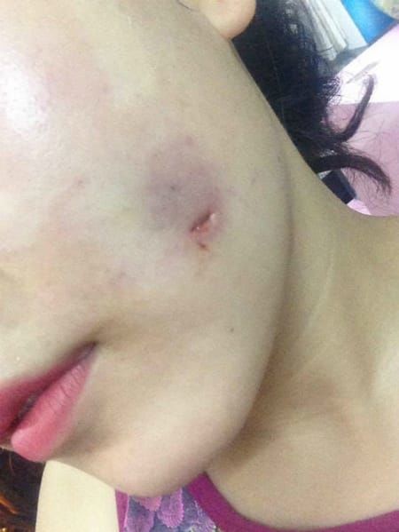 Cô gái 16 tuổi mặt mưng mủ sau khi tạo má lúm đồng tiền ở spa quen