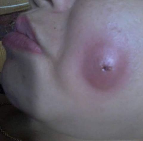 Cô gái 16 tuổi mặt mưng mủ sau khi tạo má lúm đồng tiền ở spa quen
