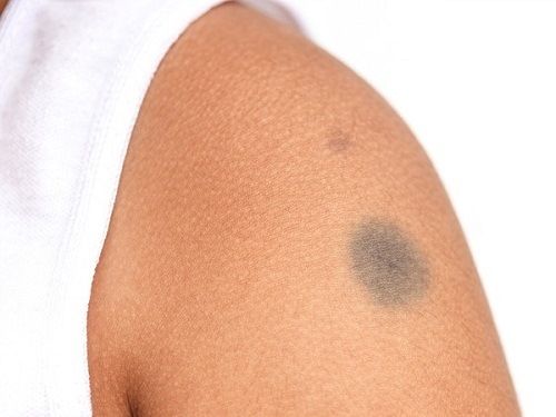 Xem vị trí vết bớt đoán chuẩn vận mệnh, nhân duyên