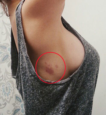 4 vị trí xuất hiện vết bớt báo hiệu người có số thiên kim