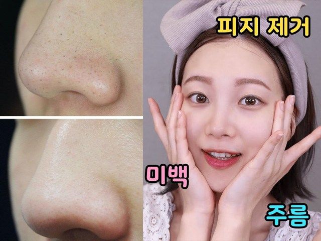 Dùng vaseline và dầu tẩy trang giúp đẩy nhân mụn còn se lỗ chân lông