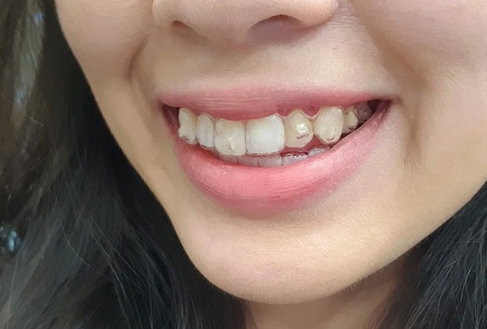 Lần đầu ra mắt nhà chồng tương lai, cô gái bị chê vì hàm răng hô