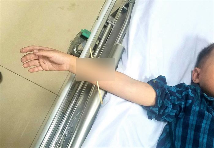 Quảng Ninh: Hy hữu bé trai 6 tuổi bị que xiên thịt xuyên qua cánh tay