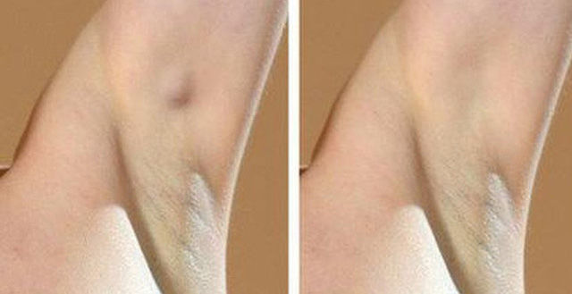 Cô giáo trẻ mắc bệnh nan y, khao khát sống dù mới cắt 1 bên ngực
